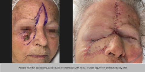 Before and after images of facial skin cancer excision and reconstruction using a frontal rotation flap