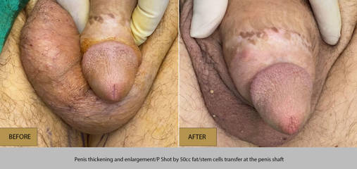 Before and after penile thickening and enlargement with P-Shot and 50cc fat and stem cell transfer