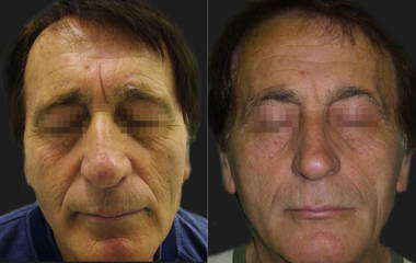 Before and after surgical eyebrow lift showing elevated brows and refreshed upper-face appearance 