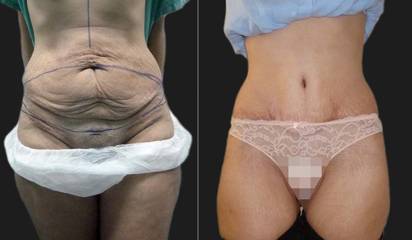 Abdominoplasty before and after showing removal of sagging abdominal skin and tightening of the lower belly