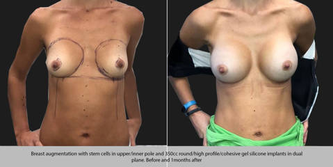 Breast augmentation with stem cells in upper and inner pole and 350cc silicone implant in dual plane