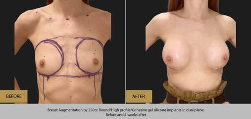 Breast augmentation by 350cc silicone implants in dual plane, before and 4 weeks after