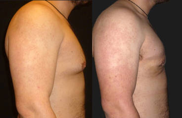 Side view before and after male gynecomastia surgery showing flatter chest and improved profile