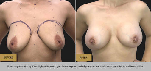 Before and after breast augmentation with 400cc high profile round silicone implants and lift