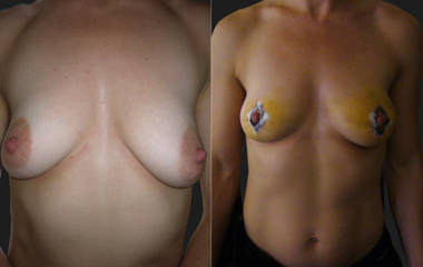 Before and after breast lift showing improved contour and nipple position after vertical mastopexy
