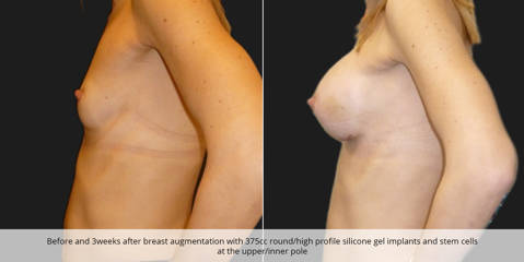 Before and 3 weeks after breast augmentation with 375cc silicon gel implants and stem cells at the upper and inner pole