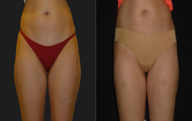 Before and after comparison of a woman's abdomen and thighs showing reduced fat and smoother body contour