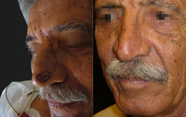 Before and after nasal skin cancer removal and reconstructive surgery, with healed nose afterward