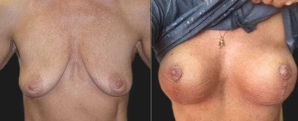 Before and after breast lift showing restored firmness, higher nipple placement, and natural upper pole fullness