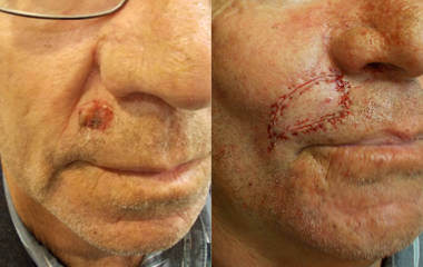 Before and after excision and suturing of a skin lesion on the upper lip area, after skin cancer removal surgery