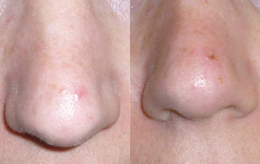 Before and after treatment of spider veins on the nose showing reduction in visible veins