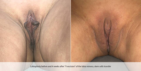 Labiaplasty before and 4 weeks after V excision of the labia minora, stem cells transfer