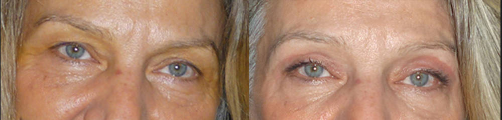 Upper eyelid blepharoplasty showing rejuvenation of the eye area, before and after procedure