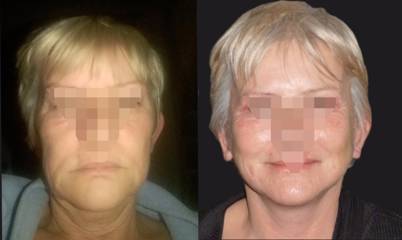 Before and after facelift showing smoother jawline, tighter neck skin, and refreshed lower-face contour