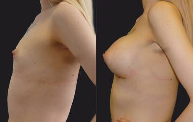 Before and after breast augmentation with silicone implants showing enhanced volume and refined upper-pole contour