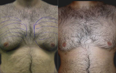 Before and after gynecomastia correction showing removal of excess tissue and improved chest definition