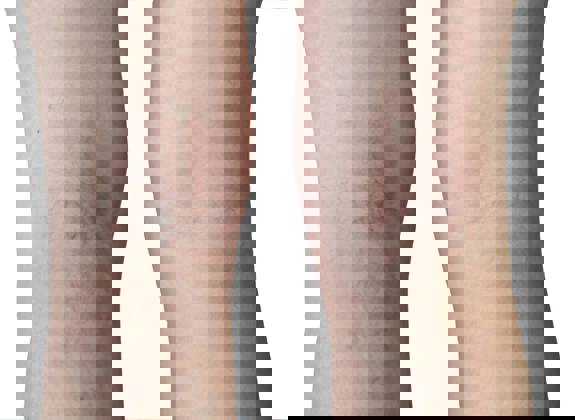Legs showing visible spider and varicose veins on the lower limbs