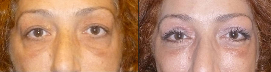 Before and after lower blepharoplasty showing reduction of under-eye bags and improved eyelid definition