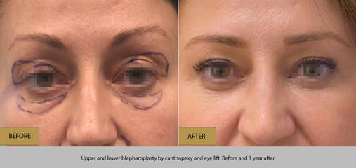 Before and after upper and lower blepharoplasty with canthopexy and eyelift showing smoother under-eye area