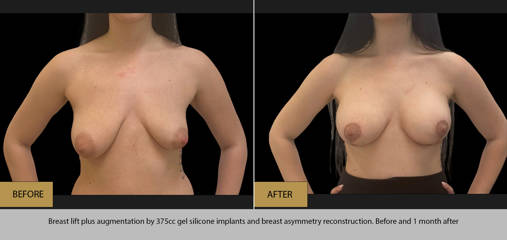 Breast lift plus augmentation by 375cc silicone implants and breast asymmetry reconstruction, before and 1 month after