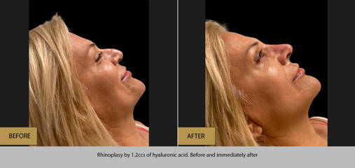 Side view before and after non-surgical rhinoplasty using 1.2cc of hyaluronic acid