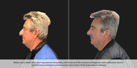 Male profile before and 2 weeks after open septoplasty and rhinoplasty with dorsal hump reduction and cartilage reshaping
