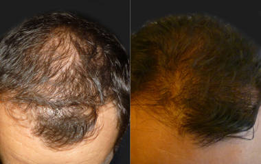 Before and after hair transplantation showing thicker hair coverage and restored frontal scalp